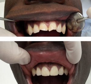 Facettes dentaires sur incisives - docteur vimazal