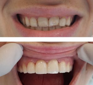 Facettes dentaires sourire - docteur vimazal